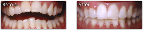 Before and After of Reverse Smile Treatment
